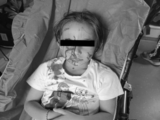 Esenyurt’ta başıboş köpek 6 yaşındaki kızın suratını parçaladı