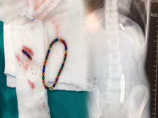 Çocuğun midesinden 42 adet mıknatıs topu çıktı!