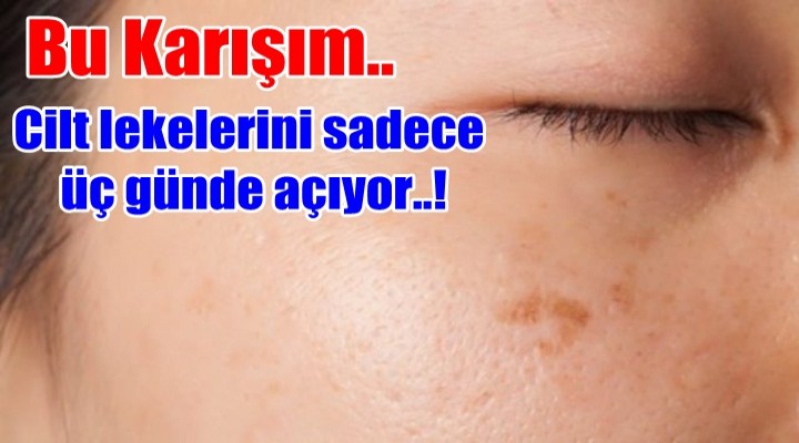 Cilt lekelerini son.!