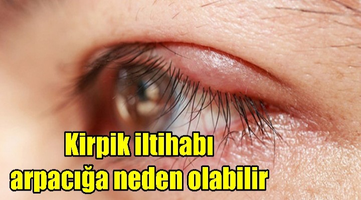 Kirpik iltihabı arpacığa neden olabilir